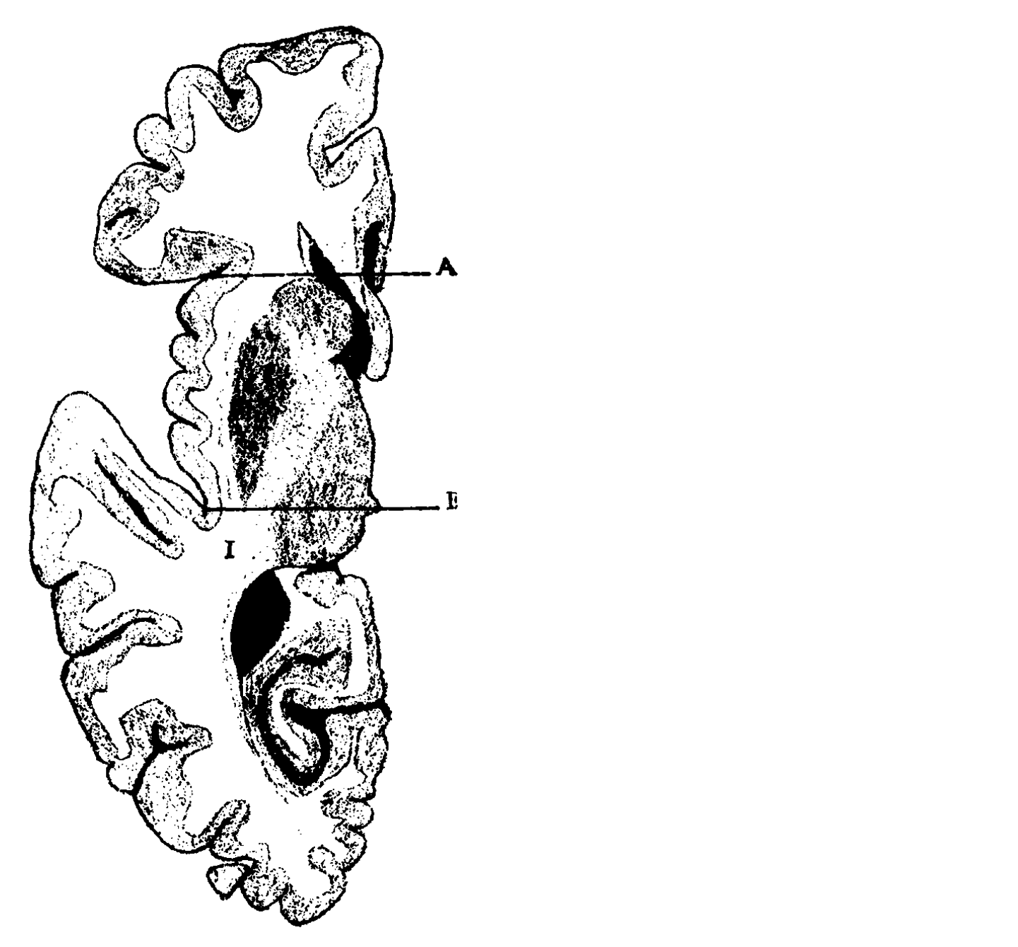Marie's diagram of the quadrilateral space — a brain section with lines A and B